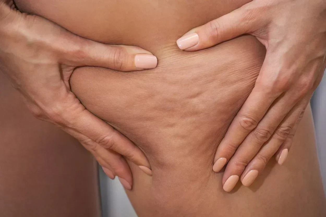 Cellulitis massage met afslankende algen | Behandel cellulitis Cellulitis massage met afslankende algen | Behandel cellulitis